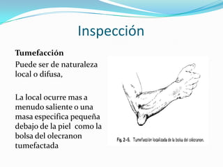 Inspección
Tumefacción
Puede ser de naturaleza
local o difusa,

La local ocurre mas a
menudo saliente o una
masa especifica pequeña
debajo de la piel como la
bolsa del olecranon
tumefactada
 