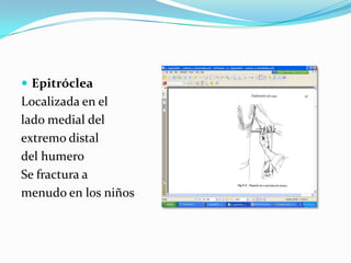  Epitróclea
Localizada en el
lado medial del
extremo distal
del humero
Se fractura a
menudo en los niños
 