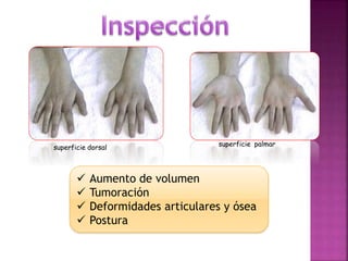 DEFORMIDAD
Manos en ráfaga:
desviación cubital de
todos los dedos de
las manos a nivel de
MCF
Dedos de cuello de cisne:
hi...