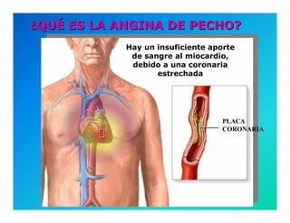 Semiología de la Angina de Pecho