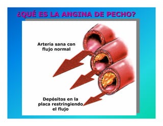 Semiología de la Angina de Pecho