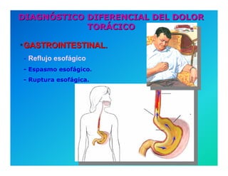 Semiología de la Angina de Pecho
