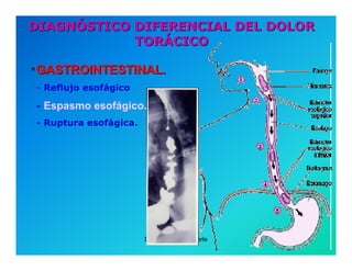 Semiología de la Angina de Pecho
