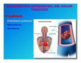 Semiología de la Angina de Pecho
