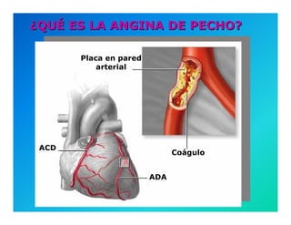 Semiología de la Angina de Pecho