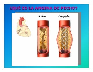 Semiología de la Angina de Pecho