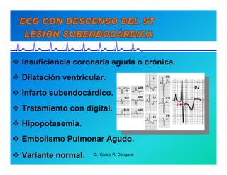 Semiología de la Angina de Pecho