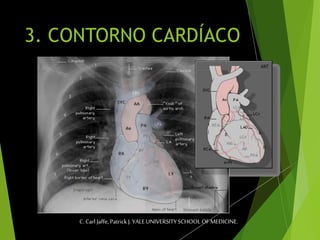 3. CONTORNO CARDÍACO
C. Carl Jaffe, Patrick J. YALE UNIVERSITYSCHOOL OF MEDICINE.
 