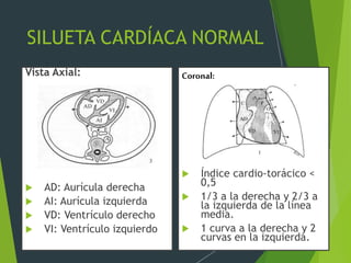 SILUETA CARDÍACA NORMAL
Vista Axial:
 AD: Aurícula derecha
 AI: Aurícula izquierda
 VD: Ventrículo derecho
 VI: Ventrículo izquierdo
 Índice cardio-torácico <
0,5
 1/3 a la derecha y 2/3 a
la izquierda de la línea
media.
 1 curva a la derecha y 2
curvas en la izquierda.
1
2
3
4
Coronal:
 