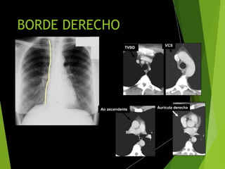 BORDE DERECHO
Aurícula derechaAo ascendente
VCS
TVBD
 