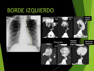 BORDE IZQUIERDO
TVB
I
ASI
Cayado
aórtico
Tronco de la
art.
pulmonar
Orejuela
aurícula
izquierda
Ventrículo
izquierdo
 