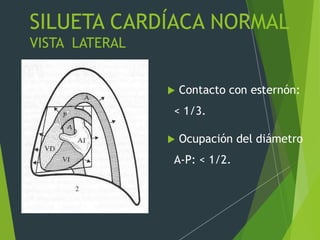 SILUETA CARDÍACA NORMAL
VISTA LATERAL
 Contacto con esternón:
< 1/3.
 Ocupación del diámetro
A-P: < 1/2.
 