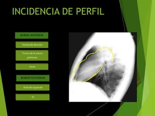 INCIDENCIA DE PERFIL
BORDE ANTERIOR
Ventrículo derecho
Troncode la arteria
pulmonar
BORDE POSTERIOR
Aorta
Aurícula izquierda
VI
 