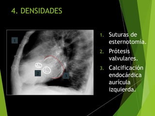 4. DENSIDADES
1. Suturas de
esternotomía.
2. Prótesis
valvulares.
3. Calcificación
endocárdica
aurícula
izquierda.
1
3
2
 