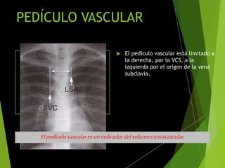 PEDÍCULO VASCULAR
 El pedículo vascular está limitado a
la derecha, por la VCS, a la
izquierda por el origen de la vena
subclavia.
60-80 mm
Elpedículovascularesunindicadordelvolumenintravascular.
 