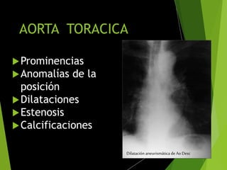 AORTA TORACICA
Prominencias
Anomalías de la
posición
Dilataciones
Estenosis
Calcificaciones
Dilatación aneurismática de Ao Desc
 
