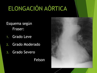 ELONGACIÓN AÓRTICA
Esquema según
Fraser:
1. Grado Leve
2. Grado Moderado
3. Grado Severo
Felson
 