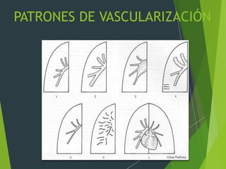 PATRONES DE VASCULARIZACIÓN
CésarPedrosa
 