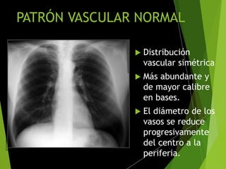 PATRÓN VASCULAR NORMAL
 Distribución
vascular simétrica
 Más abundante y
de mayor calibre
en bases.
 El diámetro de los
vasos se reduce
progresivamente
del centro a la
periferia.
 