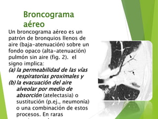 Broncograma
aéreo
Un broncograma aéreo es un
patrón de bronquios llenos de
aire (baja-atenuación) sobre un
fondo opaco (alta-atenuación)
pulmón sin aire (fig. 2). el
signo implica:
(a) la permeabilidad de las vías
respiratorias proximales y
(b) la evacuación del aire
alveolar por medio de
absorción (atelectasia) o
sustitución (p.ej., neumonía)
o una combinación de estos
procesos. En raras
 