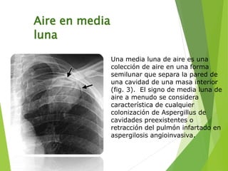 Aire en media
luna
Una media luna de aire es una
colección de aire en una forma
semilunar que separa la pared de
una cavidad de una masa interior
(fig. 3). El signo de media luna de
aire a menudo se considera
característica de cualquier
colonización de Aspergillus de
cavidades preexistentes o
retracción del pulmón infartado en
aspergilosis angioinvasiva.
 
