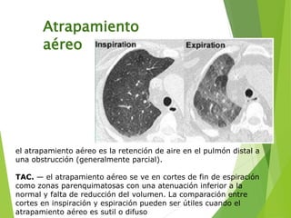 Atrapamiento
aéreo
el atrapamiento aéreo es la retención de aire en el pulmón distal a
una obstrucción (generalmente parcial).
TAC. — el atrapamiento aéreo se ve en cortes de fin de espiración
como zonas parenquimatosas con una atenuación inferior a la
normal y falta de reducción del volumen. La comparación entre
cortes en inspiración y espiración pueden ser útiles cuando el
atrapamiento aéreo es sutil o difuso
 