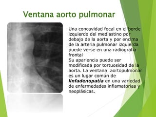 Ventana aorto pulmonar
Una concavidad focal en el borde
izquierdo del mediastino por
debajo de la aorta y por encima
de la arteria pulmonar izquierda
puede verse en una radiografía
frontal
Su apariencia puede ser
modificada por tortuosidad de la
aorta. La ventana aortopulmonar
es un lugar común de
linfadenopatía en una variedad
de enfermedades inflamatorias y
neoplásicas.
 