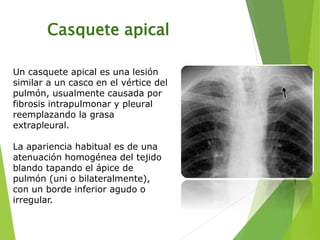 Casquete apical
Un casquete apical es una lesión
similar a un casco en el vértice del
pulmón, usualmente causada por
fibrosis intrapulmonar y pleural
reemplazando la grasa
extrapleural.
La apariencia habitual es de una
atenuación homogénea del tejido
blando tapando el ápice de
pulmón (uni o bilateralmente),
con un borde inferior agudo o
irregular.
 