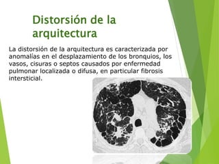 Distorsión de la
arquitectura
La distorsión de la arquitectura es caracterizada por
anomalías en el desplazamiento de los bronquios, los
vasos, cisuras o septos causados por enfermedad
pulmonar localizada o difusa, en particular fibrosis
intersticial.
 