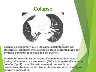 Colapso
Colapso es sinónimo y suele utilizarse indistintamente con
atelectasia, especialmente cuando es grave o acompañado por
evidente aumento de la opacidad del pulmón.
El volumen reducido se ve, acompañado de opacidad mayor
(radiografía de tórax) o atenuación (TAC) en la parte afectada del
pulmón (fig. 8). La atelectasia a menudo se asocia con
desplazamiento anormal de cisuras, bronquios, vasos, diafragma,
corazón o mediastino
 
