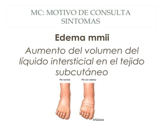 MC: MOTIVO DE CONSULTA
         SINTOMAS

         Edema mmii
  Aumento del volumen del
líquido intersticial en el tejido
          subcutáneo
 