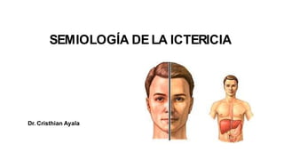 SEMIOLOGÍA DELA ICTERICIA
Dr. Cristhian Ayala
 