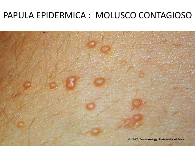 El tratamiento atopicheskogo de la dermatitis a los lactantes por la homeopatía
