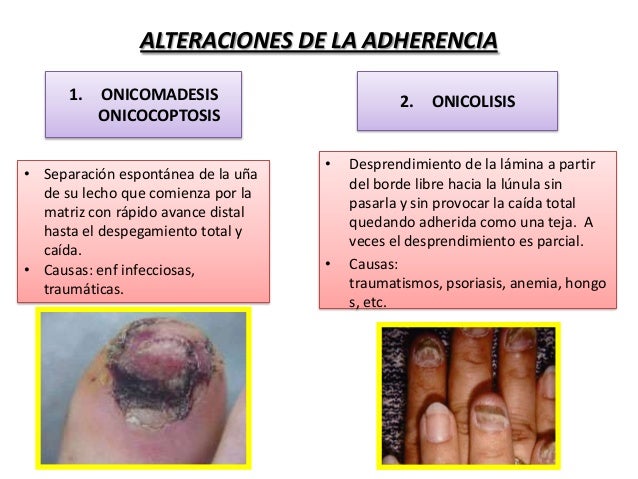 El hongo en el intestino como curar