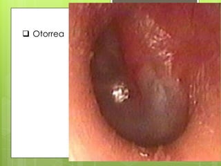  Otorrea
 