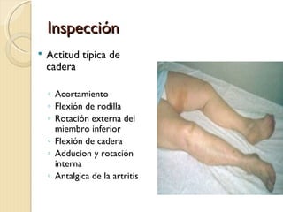 Inspección
   Actitud típica de
    cadera

    ◦ Acortamiento
    ◦ Flexión de rodilla
    ◦ Rotación externa del
      miembro inferior
    ◦ Flexión de cadera
    ◦ Adducion y rotación
      interna
    ◦ Antalgica de la artritis
 