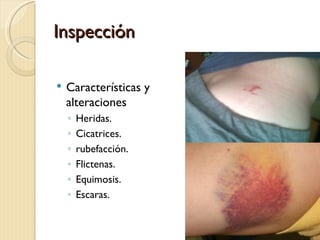 Inspección

   Características y
    alteraciones
    ◦   Heridas.
    ◦   Cicatrices.
    ◦   rubefacción.
    ◦   Flictenas.
    ◦   Equimosis.
    ◦   Escaras.
 