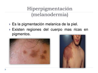 Melanoderma Semiología dermatológica | PPTX