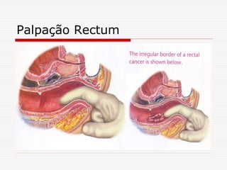 Palpação Rectum
 