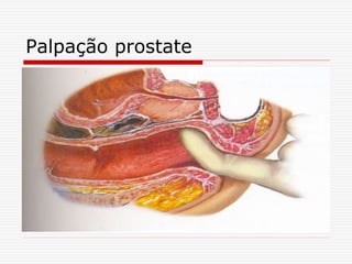 Palpação prostate
 