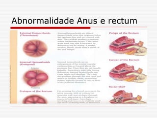 Abnormalidade Anus e rectum
 