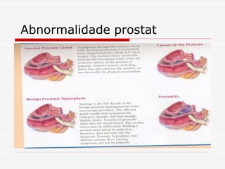 Abnormalidade prostat
 