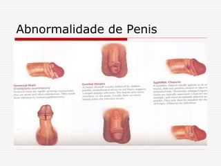 Abnormalidade de Penis
 