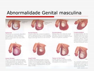 Abnormalidade Genital masculina
 