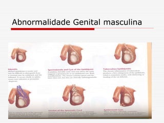 Abnormalidade Genital masculina
 