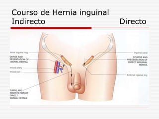 Courso de Hernia inguinal
Indirecto Directo
 