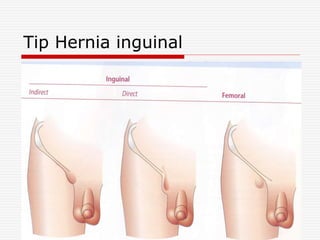 Tip Hernia inguinal
 