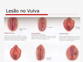 Lesão no Vulva
 
