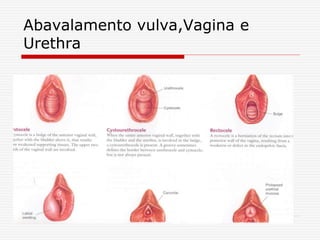 Abavalamento vulva,Vagina e
Urethra
 