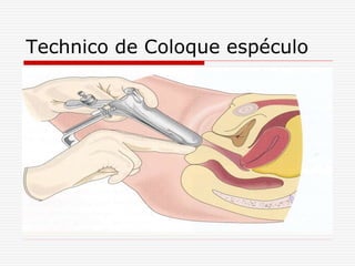 Technico de Coloque espéculo
 
